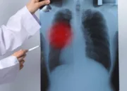 Indonesia Peringkat Kedua Tuberkulosis