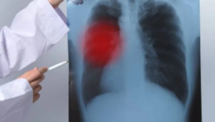 Indonesia Peringkat Kedua Tuberkulosis