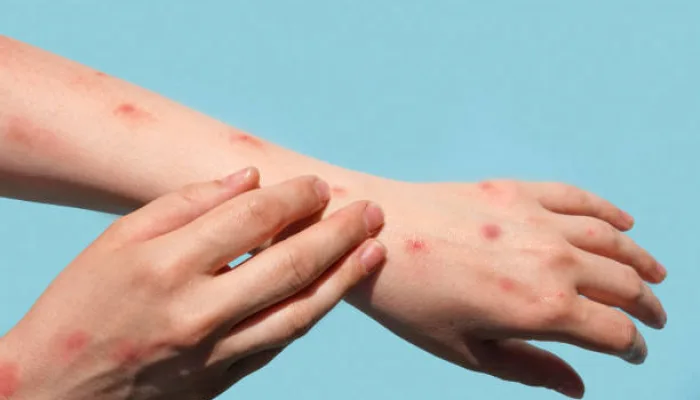Kenalan Sama Monkeypox, Si Virus Mirip Cacar yang Lagi Jadi Sorotan